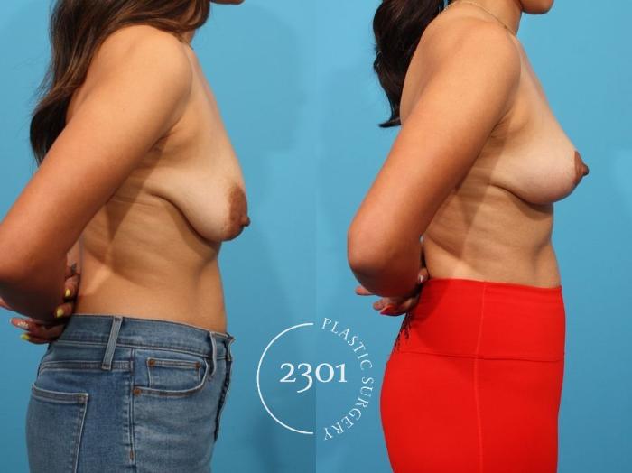 Before & After Breast Lift (Mastopexy) Case 806 Right Side View in Fort Worth, Plano, & Frisco, Texas