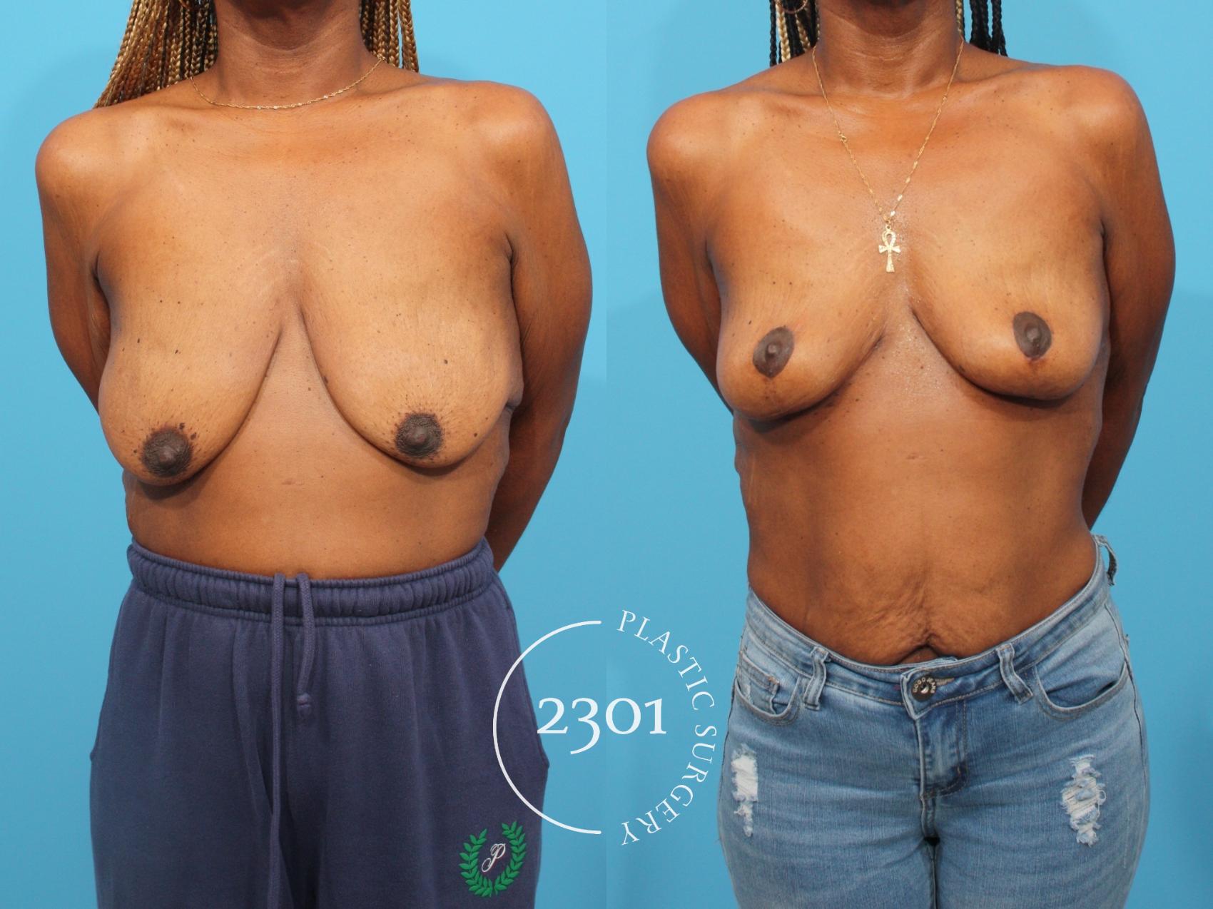 Before & After Breast Lift (Mastopexy) Case 822 Front View in Fort Worth, Plano, & Frisco, Texas