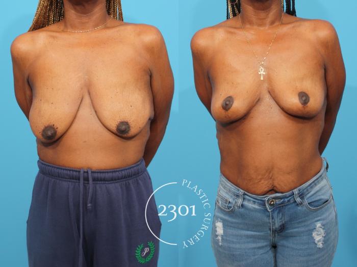 Before & After Breast Lift (Mastopexy) Case 822 Front View in Fort Worth, Plano, & Frisco, Texas