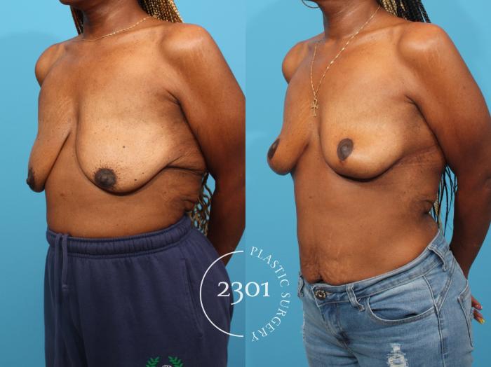 Before & After Breast Lift (Mastopexy) Case 822 Left Oblique View in Fort Worth, Plano, & Frisco, Texas