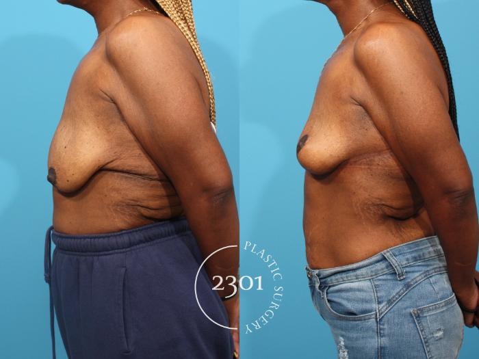 Before & After Post-Bariatric Plastic Surgery Case 822 Left Side View in Fort Worth, Plano, & Frisco, Texas