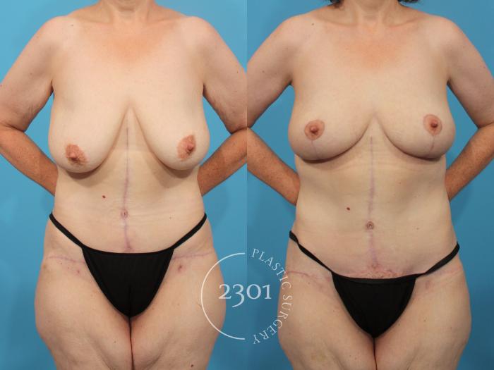 Before & After Breast Lift (Mastopexy) Case 850 Front View in Fort Worth, Plano, & Frisco, Texas