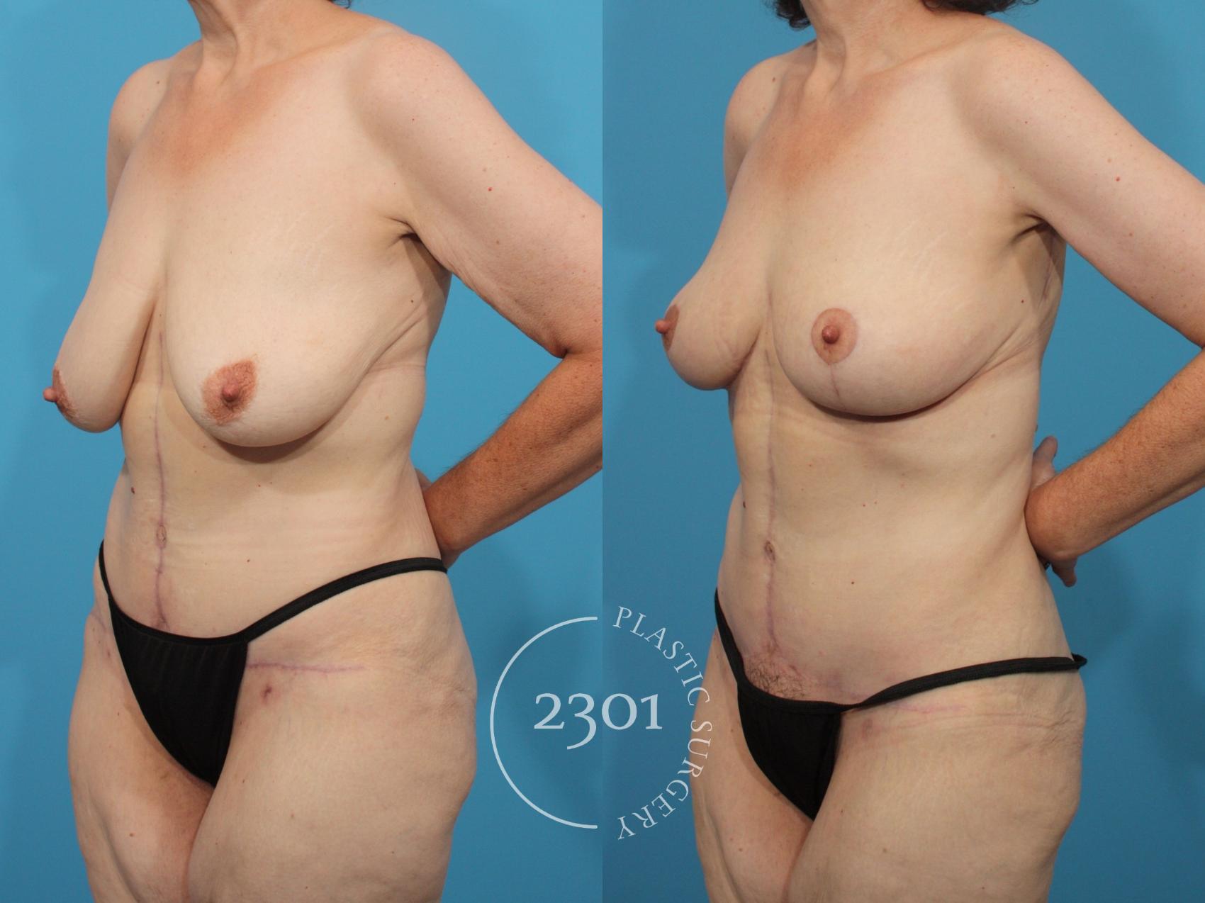 Before & After Breast Lift (Mastopexy) Case 850 Left Oblique View in Fort Worth, Plano, & Frisco, Texas