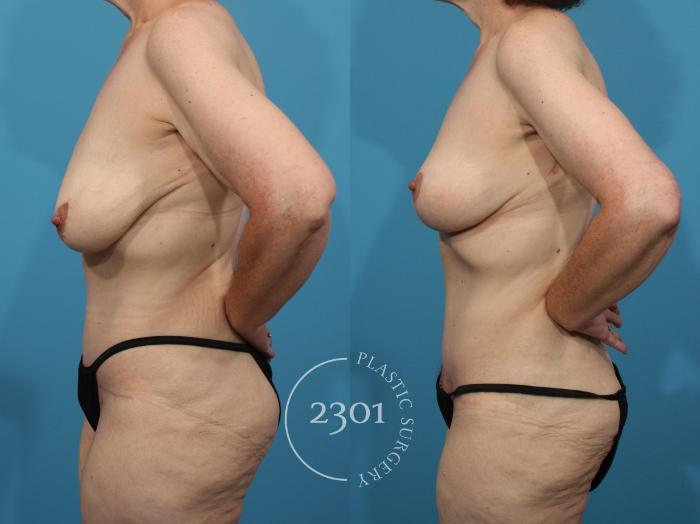 Before & After Breast Lift (Mastopexy) Case 850 Left Side View in Fort Worth, Plano, & Frisco, Texas