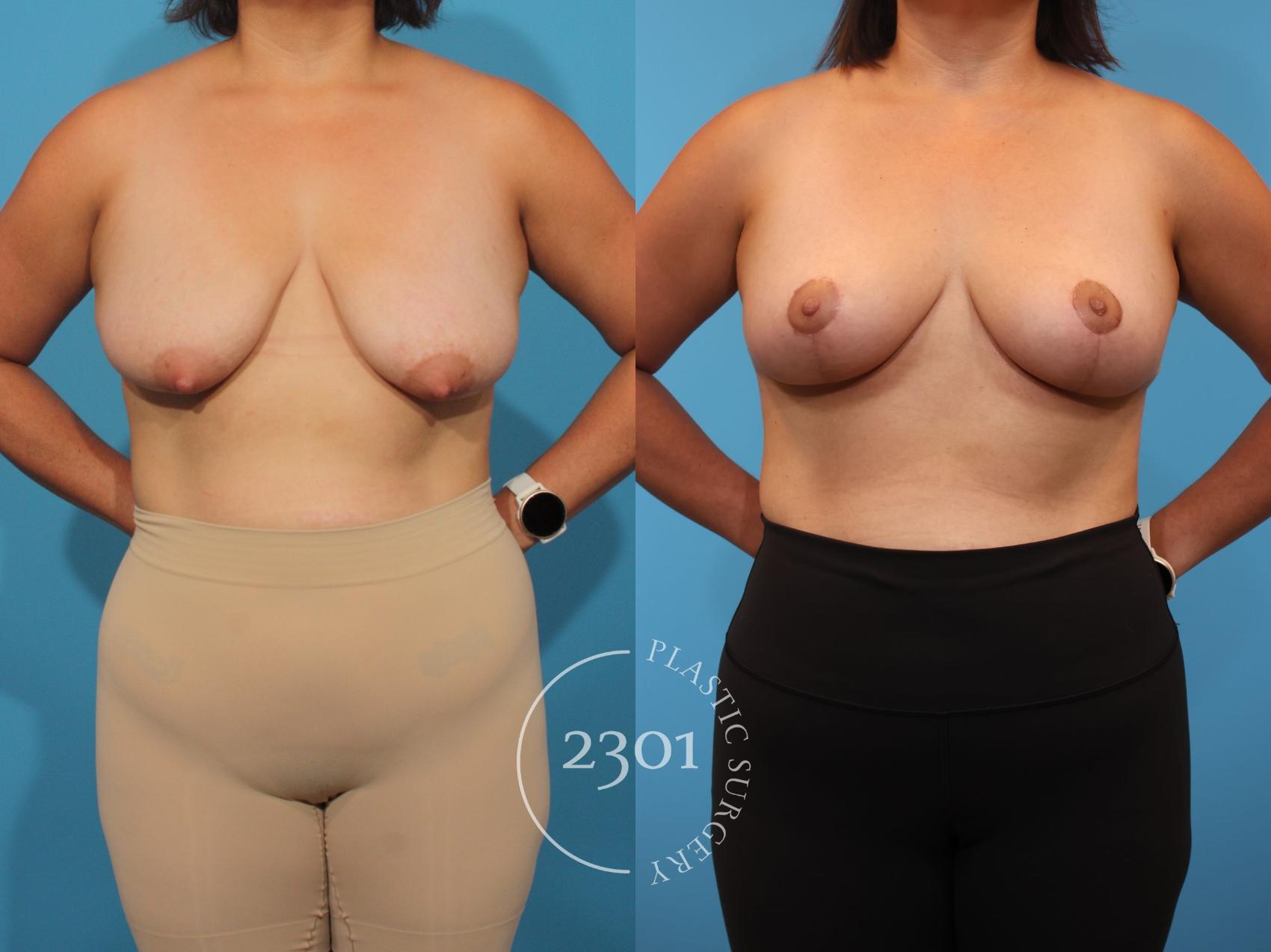 Before & After Breast Lift (Mastopexy) Case 899 Front View in Fort Worth, Plano, & Frisco, Texas