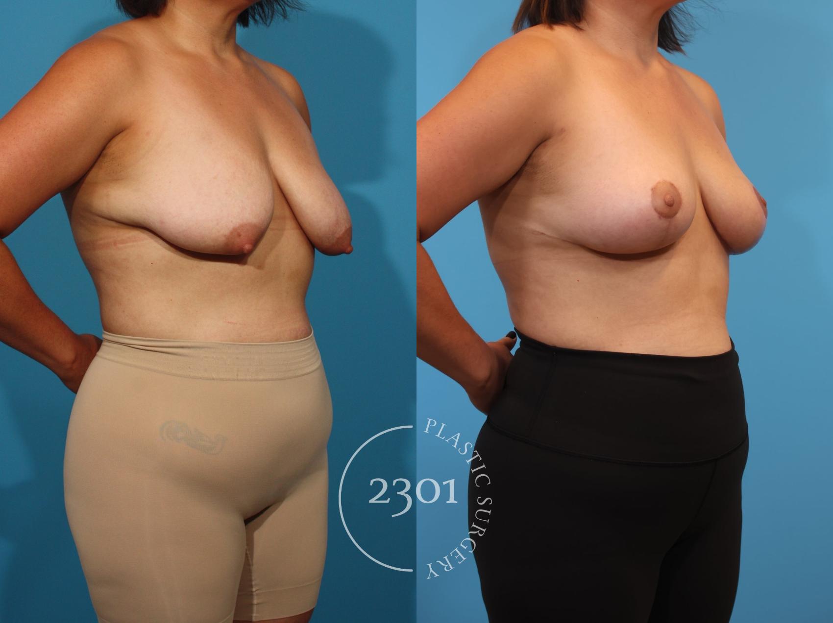 Before & After Breast Lift (Mastopexy) Case 899 Right Oblique View in Fort Worth, Plano, & Frisco, Texas