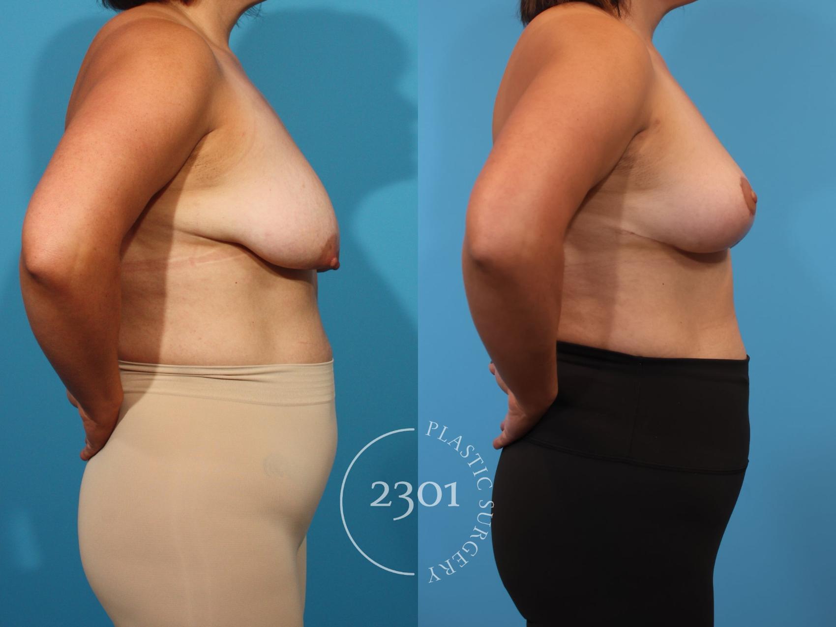 Before & After Breast Lift (Mastopexy) Case 899 Right Side View in Fort Worth, Plano, & Frisco, Texas