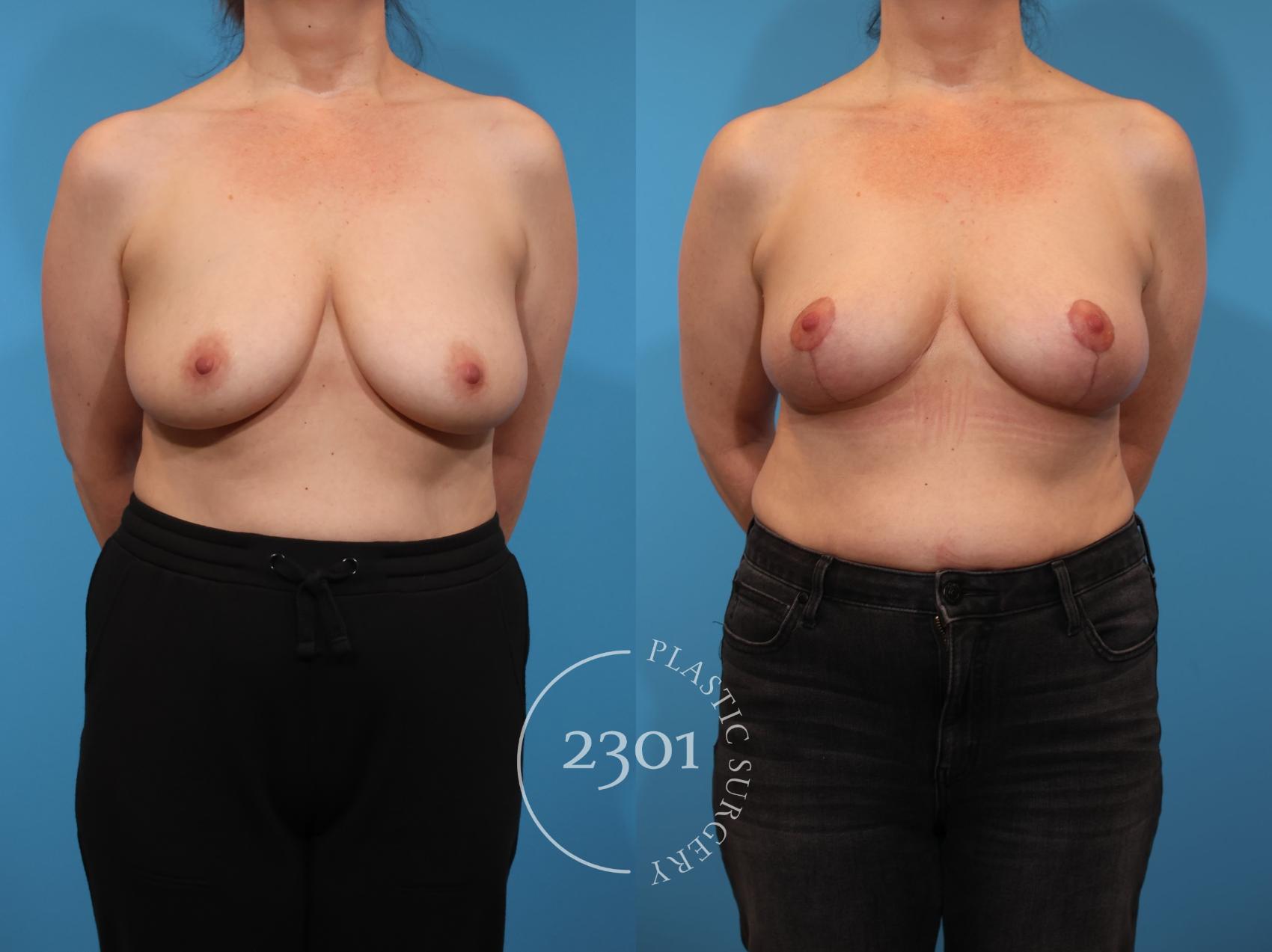 Before & After Breast Lift (Mastopexy) Case 919 Front View in Fort Worth, Plano, & Frisco, Texas