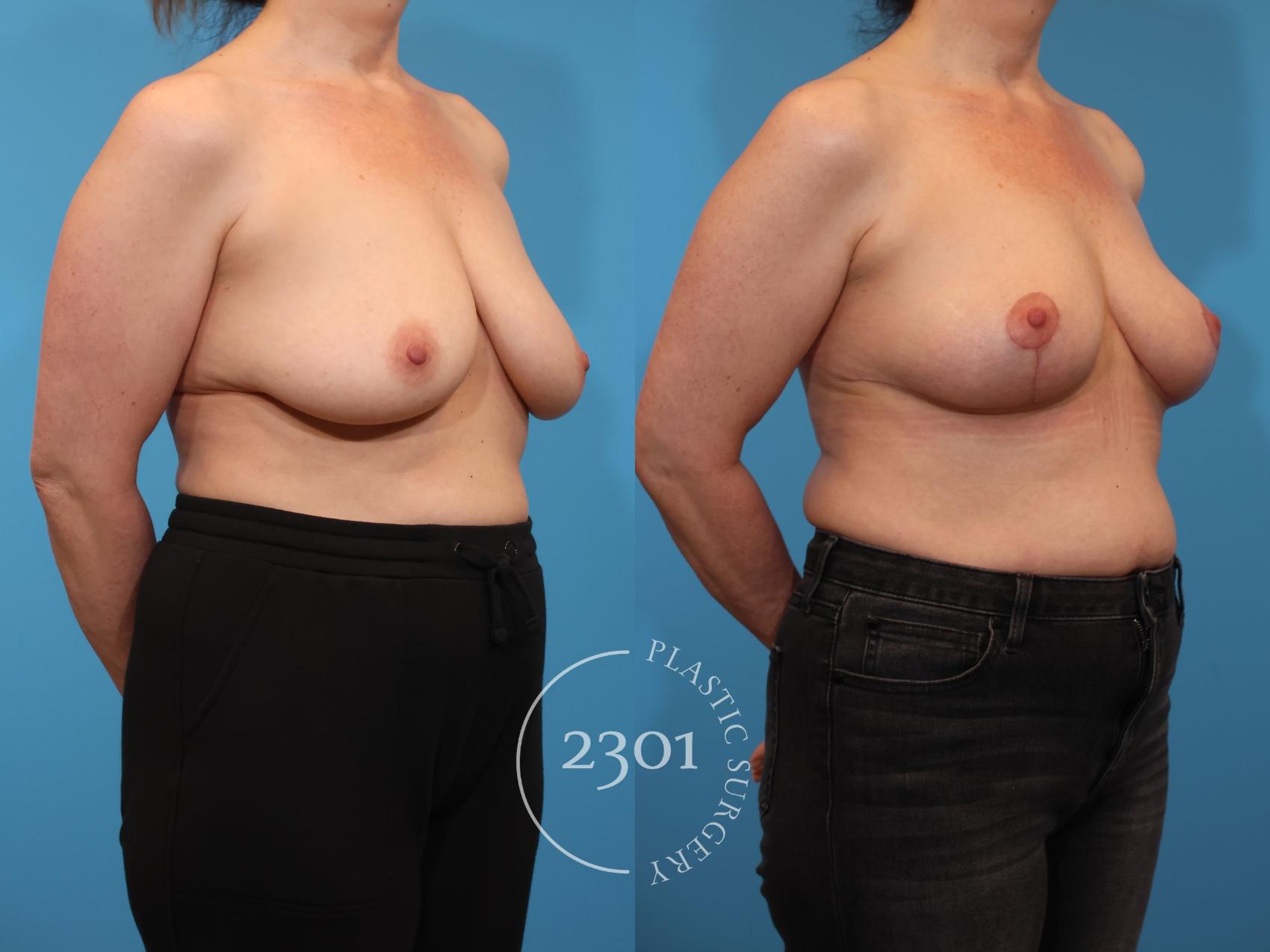 Before & After Breast Lift (Mastopexy) Case 919 Right Oblique View in Fort Worth, Plano, & Frisco, Texas