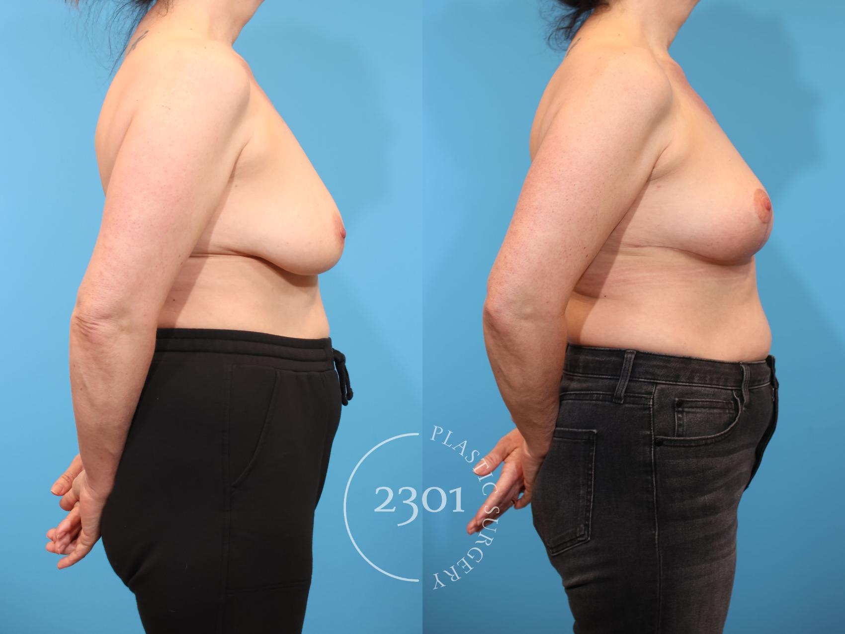 Before & After Breast Lift (Mastopexy) Case 919 Right Side View in Fort Worth, Plano, & Frisco, Texas