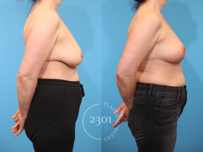 Before & After Breast Lift (Mastopexy) Case 919 Right Side View in Fort Worth, Plano, & Frisco, Texas