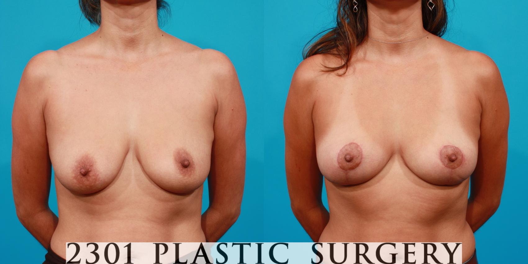 Before & After Breast Lift (Mastopexy) Case 95 View #1 View in Fort Worth, Plano, & Frisco, Texas