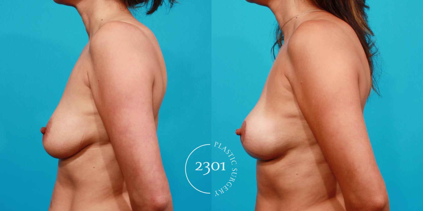 Before & After Breast Lift (Mastopexy) Case 95 View #2 View in Fort Worth, Plano, & Frisco, Texas
