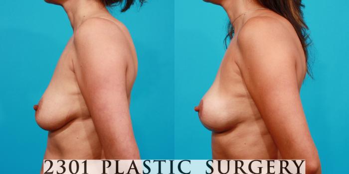 Before & After Breast Lift (Mastopexy) Case 95 View #2 View in Fort Worth, Plano, & Frisco, Texas