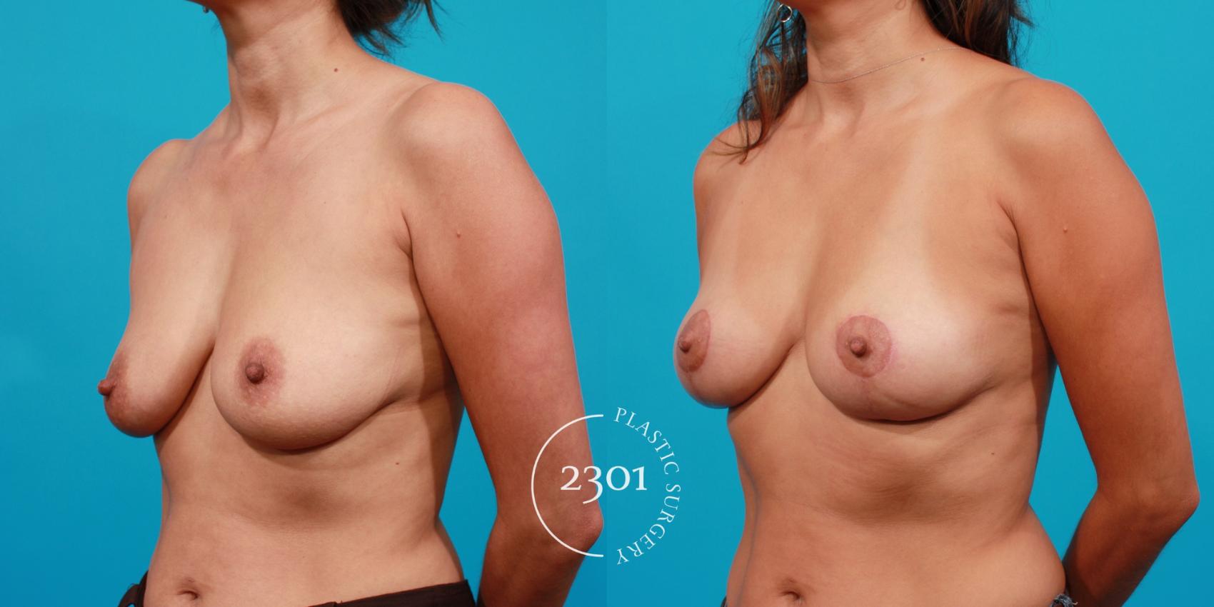 Before & After Breast Lift (Mastopexy) Case 95 View #3 View in Fort Worth, Plano, & Frisco, Texas