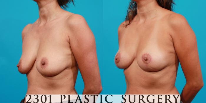 Before & After Breast Lift (Mastopexy) Case 95 View #3 View in Fort Worth, Plano, & Frisco, Texas
