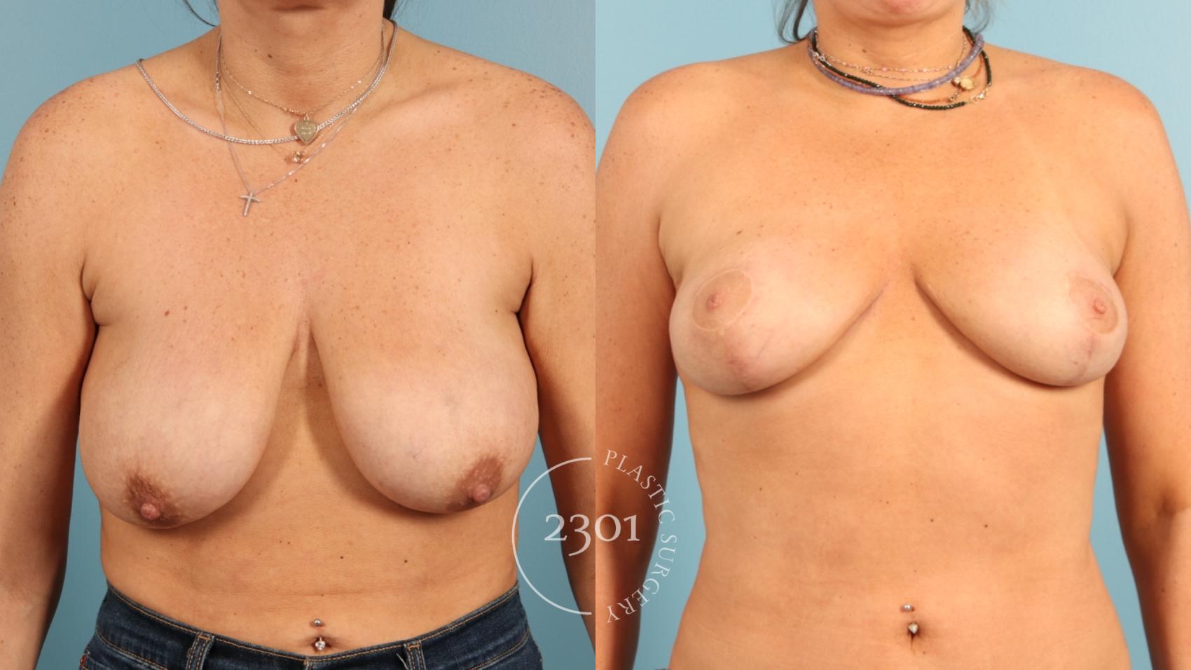 Before & After Breast Lift (Mastopexy) Case 955 Front View in Fort Worth, Plano, & Frisco, Texas