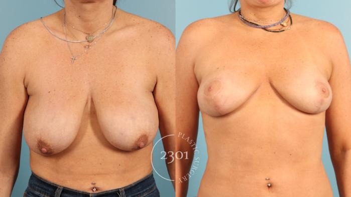Before & After Breast Lift (Mastopexy) Case 955 Front View in Fort Worth, Plano, & Frisco, Texas