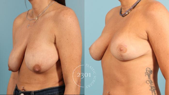 Before & After Breast Lift (Mastopexy) Case 955 Left Oblique View in Fort Worth, Plano, & Frisco, Texas