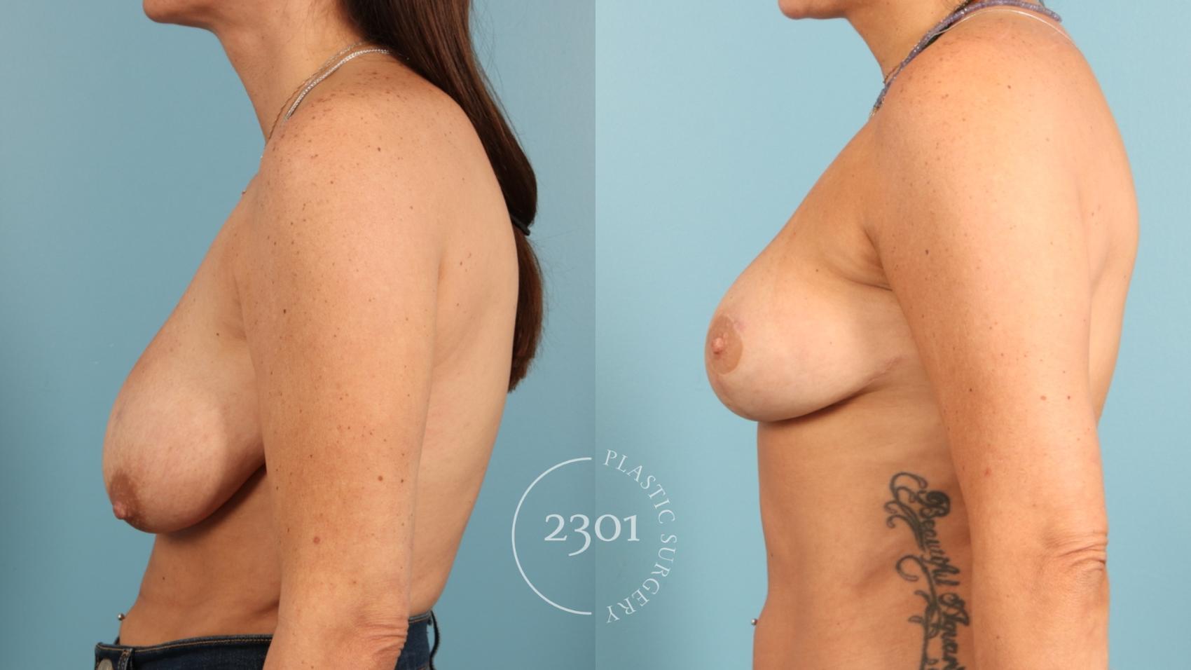 Before & After Breast Lift (Mastopexy) Case 955 Left Side View in Fort Worth, Plano, & Frisco, Texas