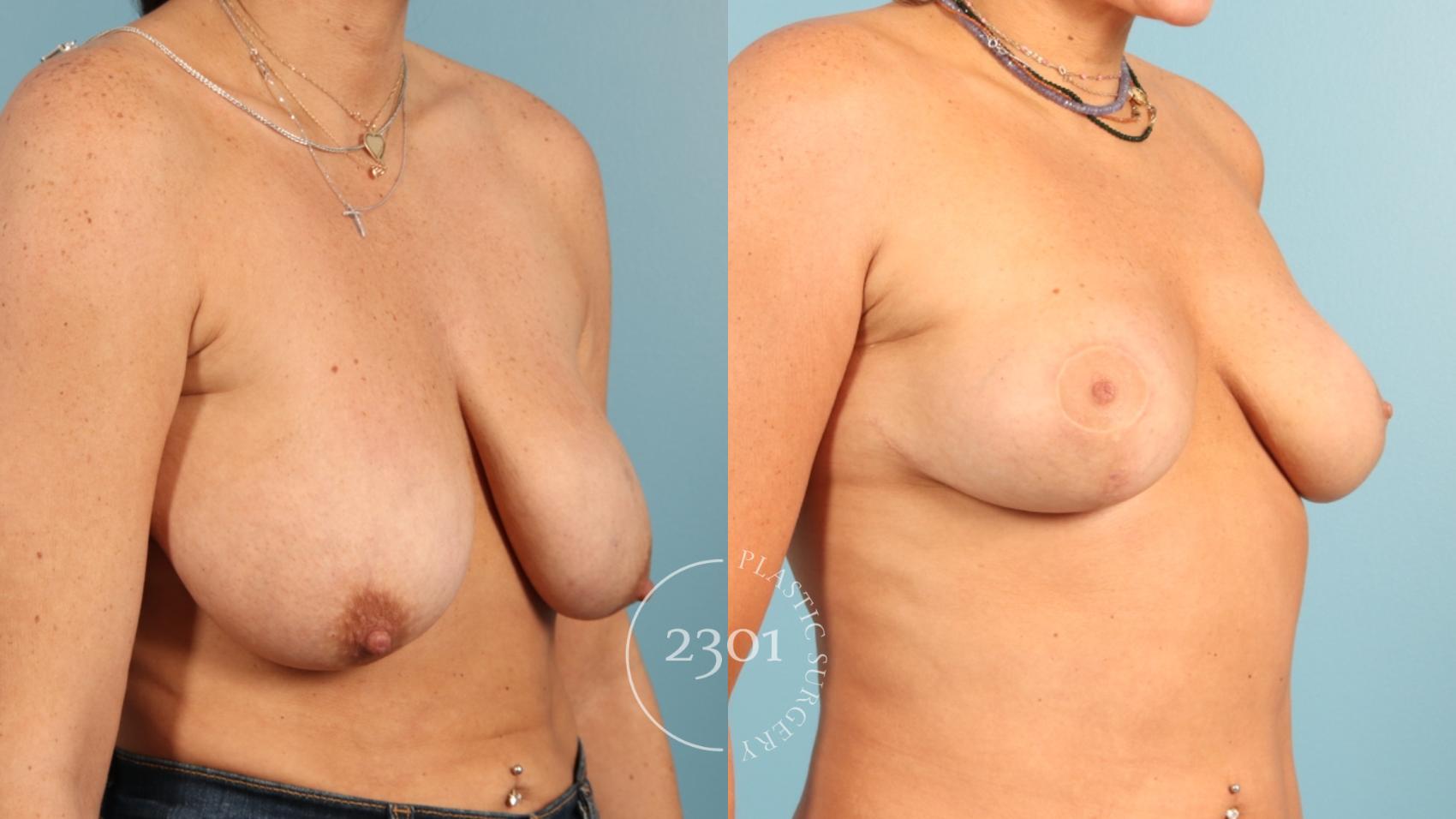 Before & After Breast Lift (Mastopexy) Case 955 Right Oblique View in Fort Worth, Plano, & Frisco, Texas