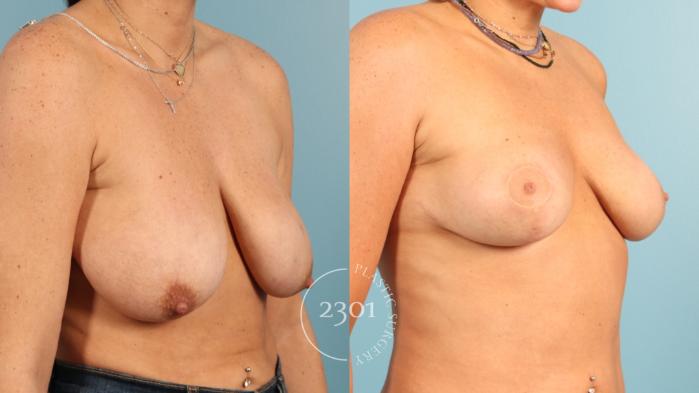 Before & After Breast Lift (Mastopexy) Case 955 Right Oblique View in Fort Worth, Plano, & Frisco, Texas
