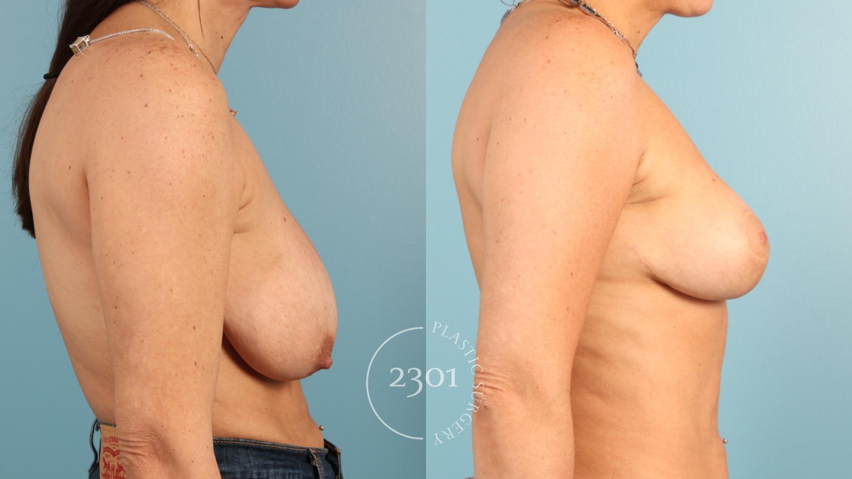 Before & After Breast Lift (Mastopexy) Case 955 Right Side View in Fort Worth, Plano, & Frisco, Texas