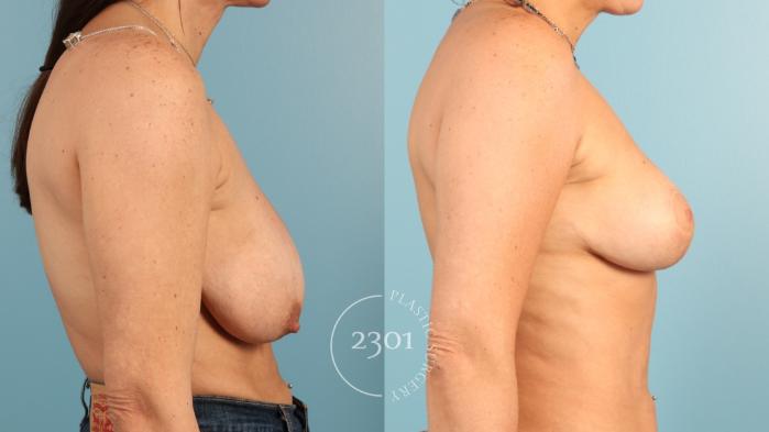 Before & After Breast Lift (Mastopexy) Case 955 Right Side View in Fort Worth, Plano, & Frisco, Texas