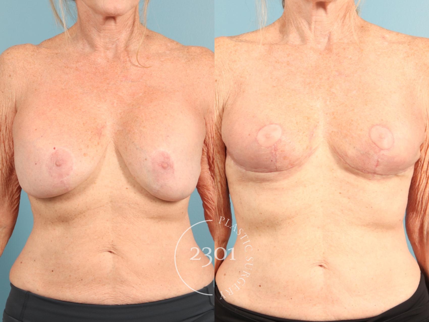 Before & After Breast Lift (Mastopexy) Case 956 Front View in Fort Worth, Plano, & Frisco, Texas
