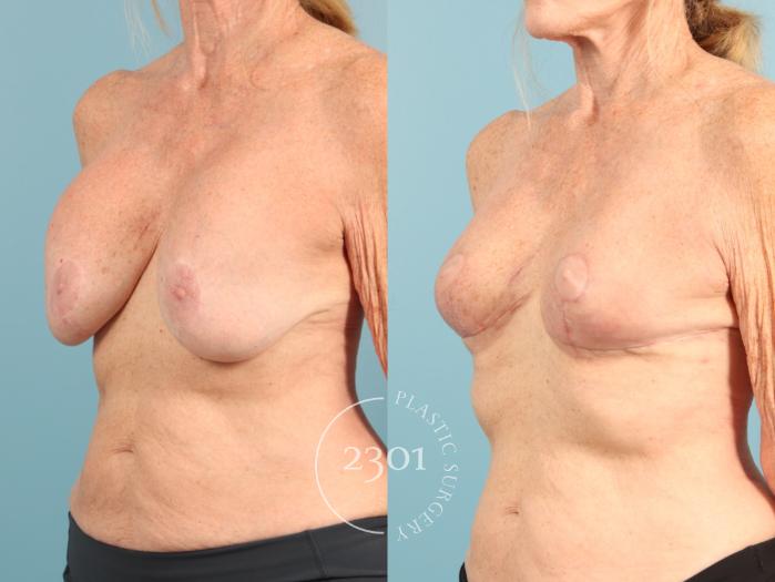 Before & After Breast Lift (Mastopexy) Case 956 Left Oblique View in Fort Worth, Plano, & Frisco, Texas