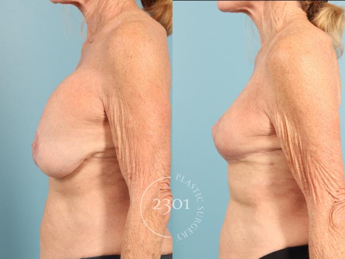 Before & After Breast Lift (Mastopexy) Case 956 Left Side View in Fort Worth, Plano, & Frisco, Texas