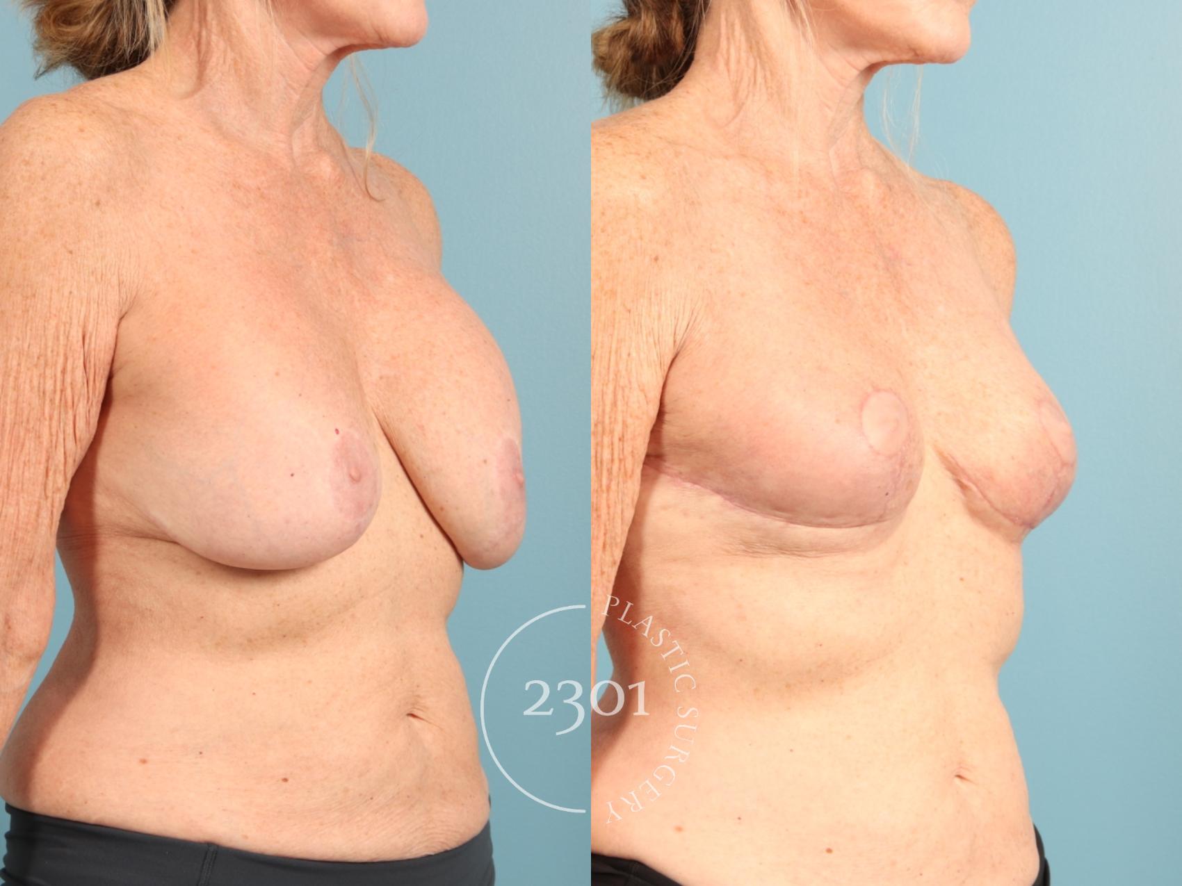 Before & After Breast Lift (Mastopexy) Case 956 Right Oblique View in Fort Worth, Plano, & Frisco, Texas