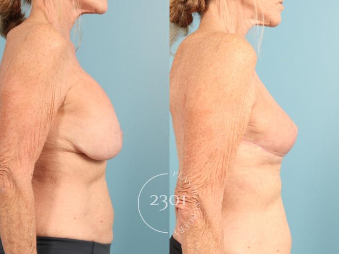 Before & After Breast Lift (Mastopexy) Case 956 Right Side View in Fort Worth, Plano, & Frisco, Texas