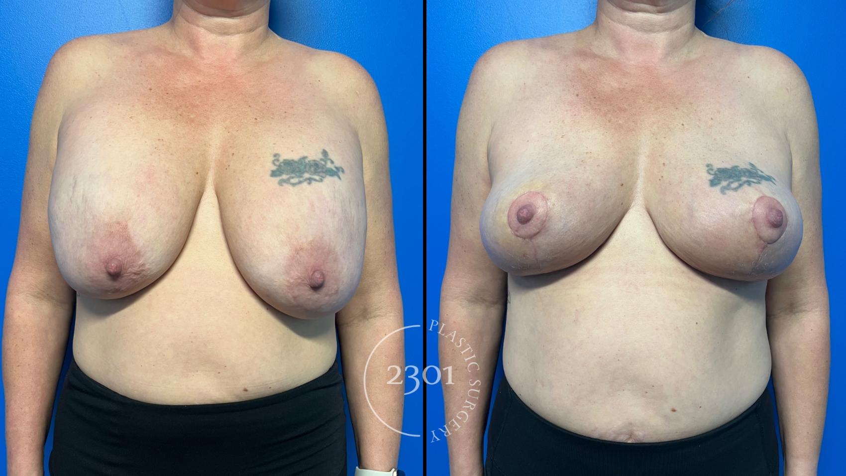 Before & After Breast Lift (Mastopexy) Case 958 Front View in Fort Worth, Plano, & Frisco, Texas