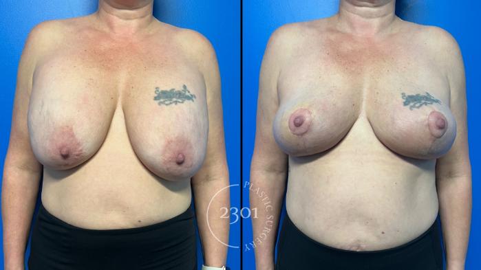 Before & After Breast Lift (Mastopexy) Case 958 Front View in Fort Worth, Plano, & Frisco, Texas