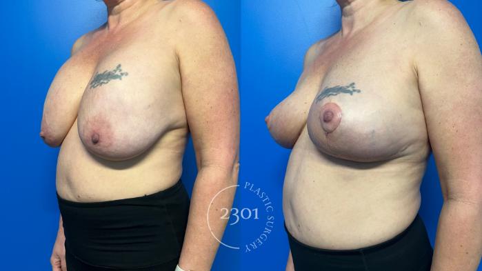 Before & After Breast Lift (Mastopexy) Case 958 Left Oblique View in Fort Worth, Plano, & Frisco, Texas