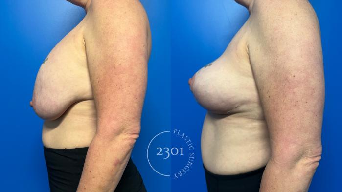 Before & After Breast Lift (Mastopexy) Case 958 Left Side View in Fort Worth, Plano, & Frisco, Texas