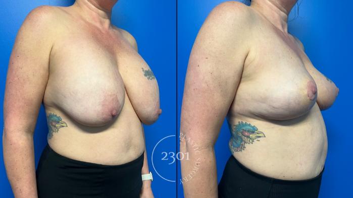 Before & After Breast Lift (Mastopexy) Case 958 Right Oblique View in Fort Worth, Plano, & Frisco, Texas