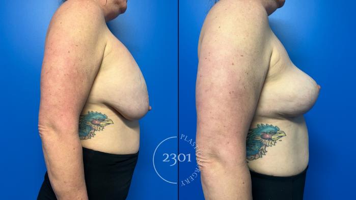 Before & After Breast Lift (Mastopexy) Case 958 Right Side View in Fort Worth, Plano, & Frisco, Texas