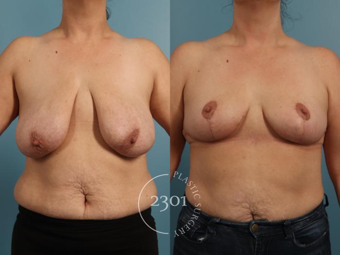 Before & After Breast Lift (Mastopexy) Case 960 Front View in Fort Worth, Plano, & Frisco, Texas