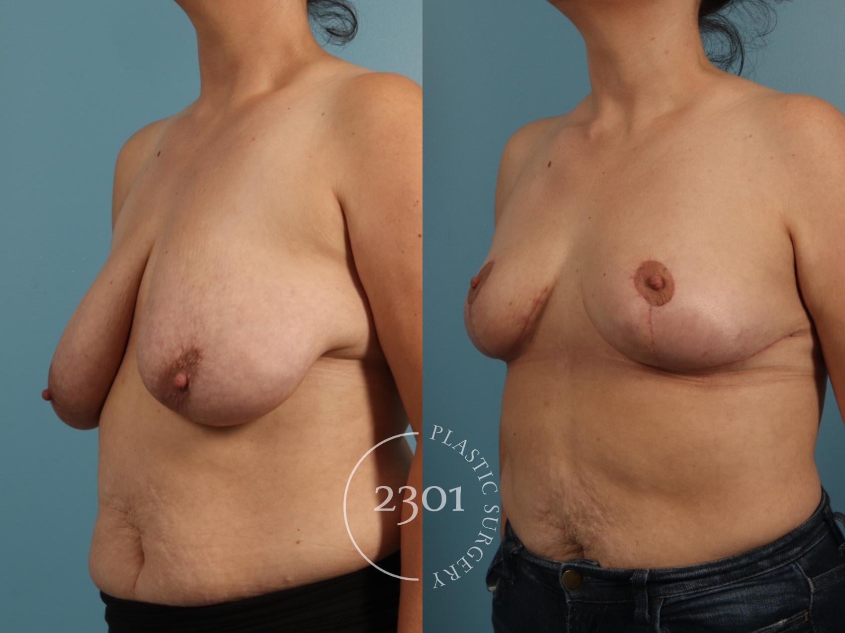 Before & After Breast Lift (Mastopexy) Case 960 Left Oblique View in Fort Worth, Plano, & Frisco, Texas