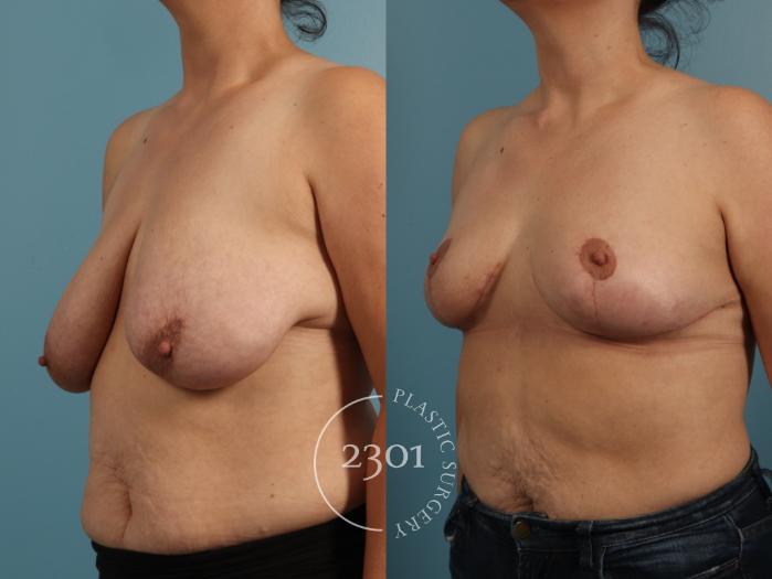 Before & After Breast Lift (Mastopexy) Case 960 Left Oblique View in Fort Worth, Plano, & Frisco, Texas