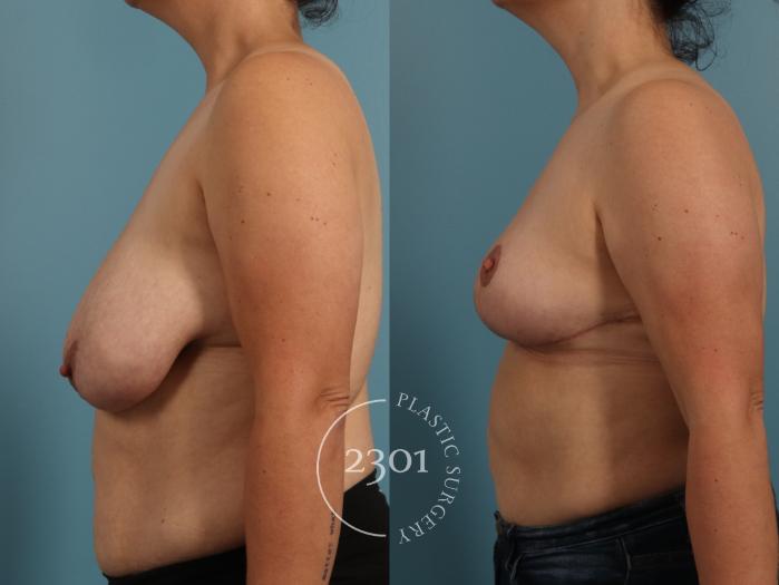Before & After Breast Lift (Mastopexy) Case 960 Left Side View in Fort Worth, Plano, & Frisco, Texas