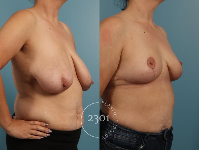 Before & After Breast Lift (Mastopexy) Case 960 Right Oblique View in Fort Worth, Plano, & Frisco, Texas