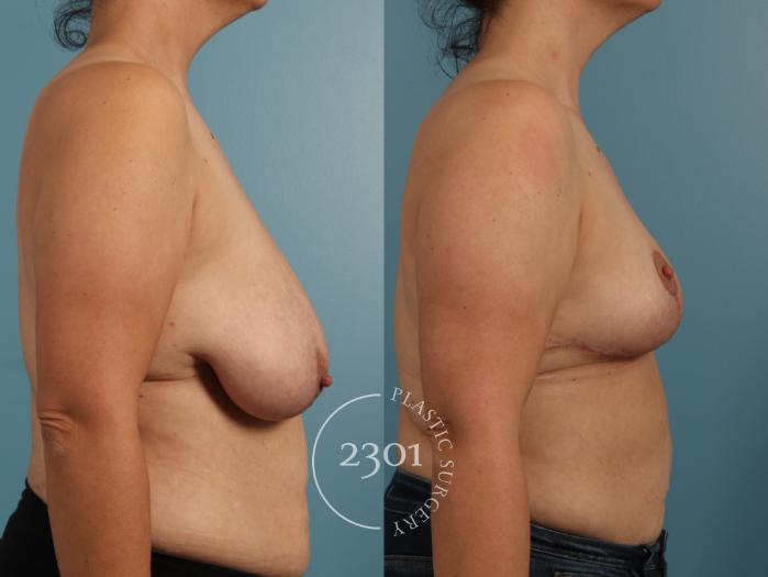 Before & After Breast Lift (Mastopexy) Case 960 Right Side View in Fort Worth, Plano, & Frisco, Texas