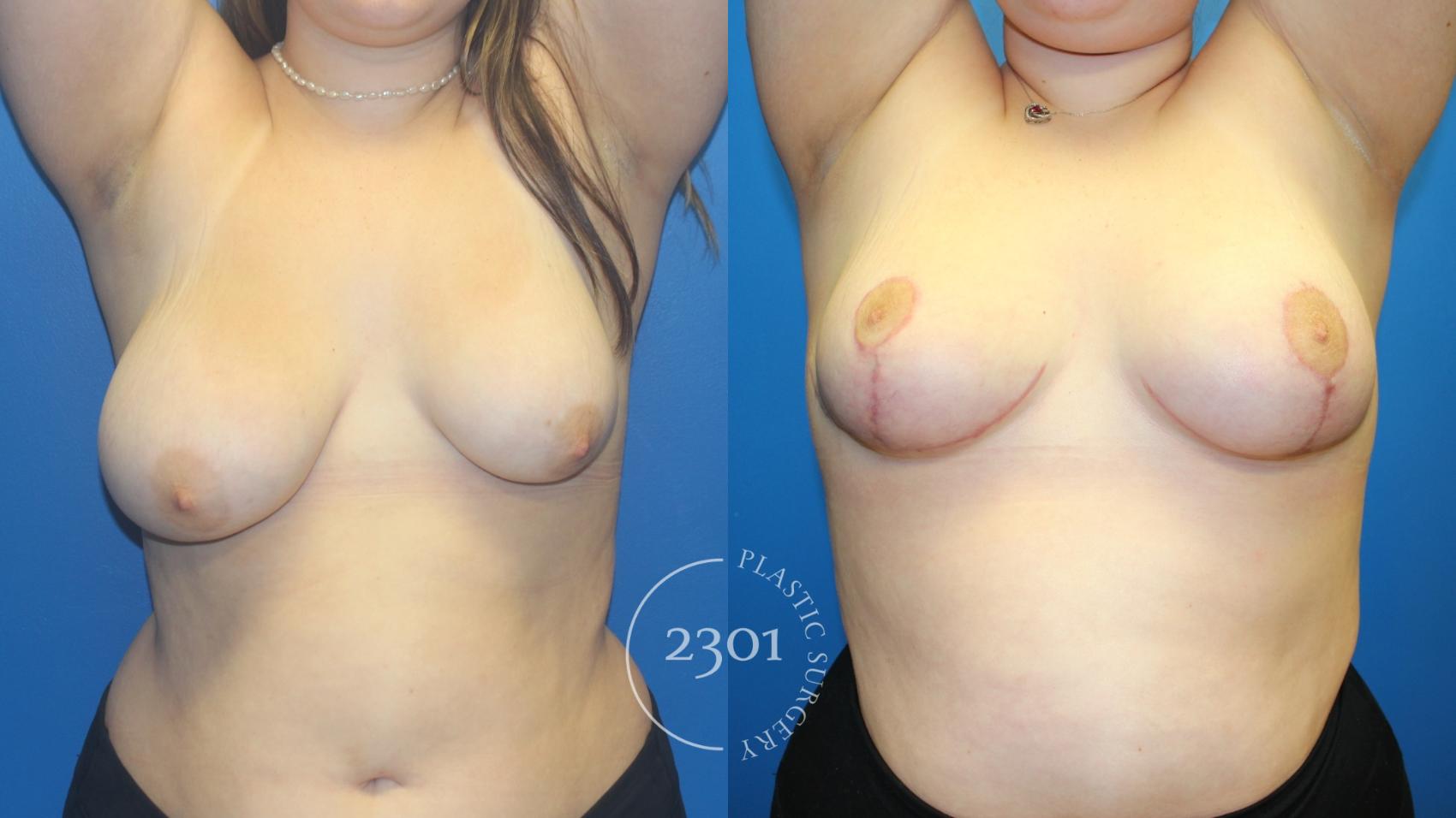 Before & After Breast Lift (Mastopexy) Case 966 Arm raised View in Fort Worth, Plano, & Frisco, Texas