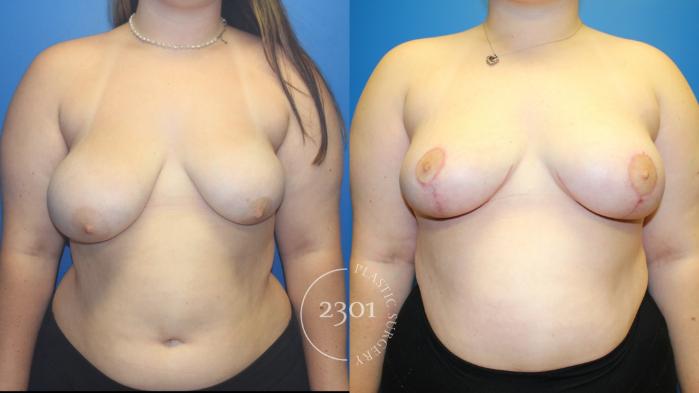 Before & After Breast Lift (Mastopexy) Case 966 Front View in Fort Worth, Plano, & Frisco, Texas