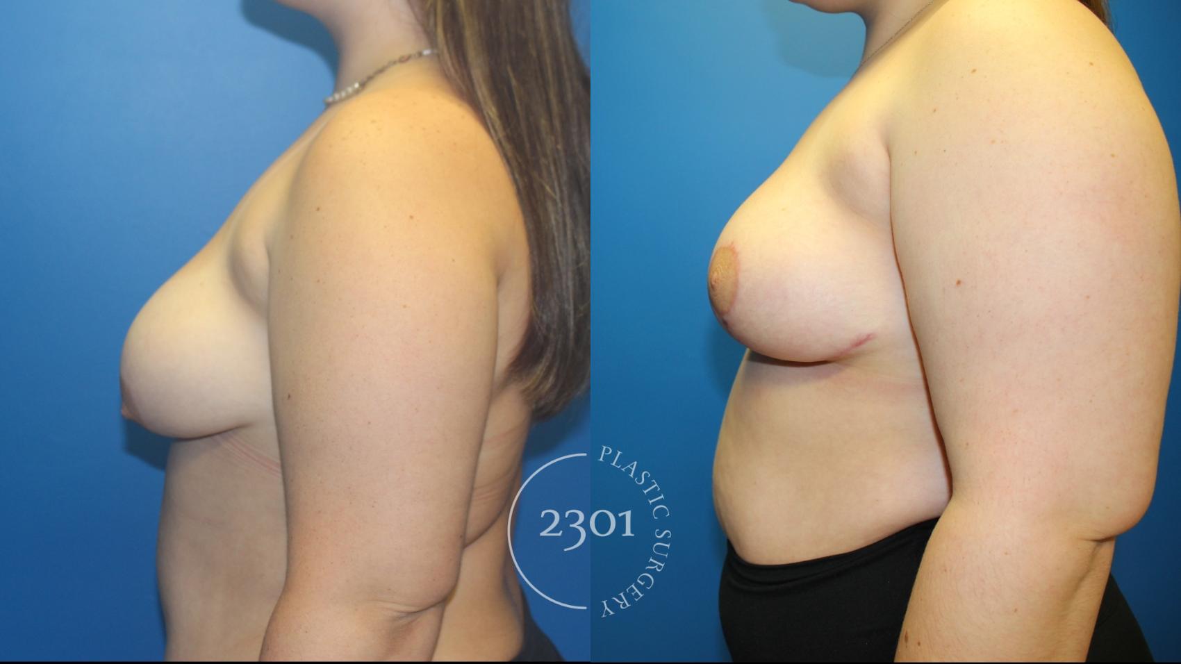 Before & After Breast Lift (Mastopexy) Case 966 Left Side View in Fort Worth, Plano, & Frisco, Texas