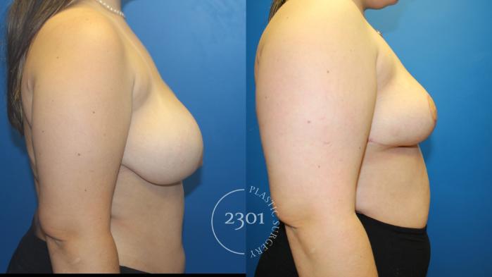 Before & After Breast Lift (Mastopexy) Case 966 Right Side View in Fort Worth, Plano, & Frisco, Texas