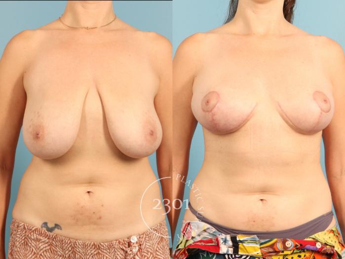 Before & After Breast Lift (Mastopexy) Case 967 Front View in Fort Worth, Plano, & Frisco, Texas